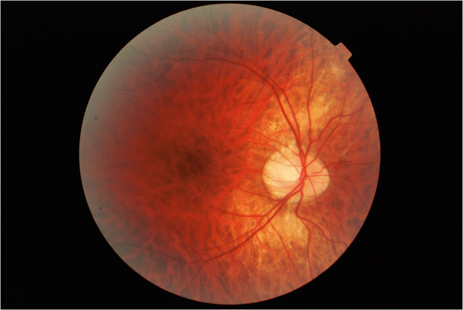 high myopia retina