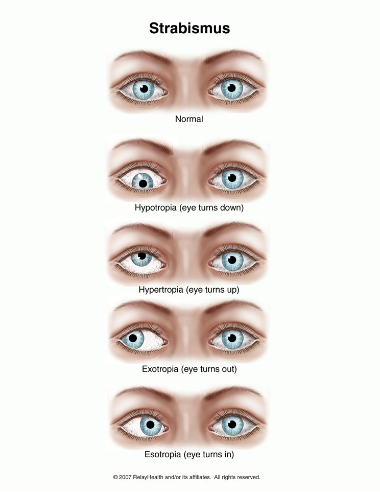 The Basics Of A Strabismus Exam 