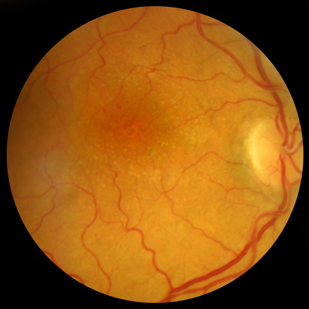 age-related-macular-degeneration-the-basics-you-should-know