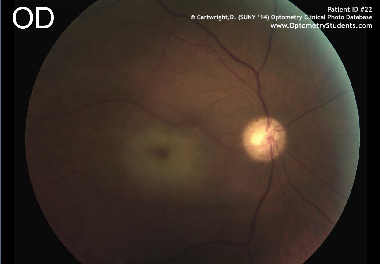 Clinical Case Review: Complete Vision Loss Od Following A 