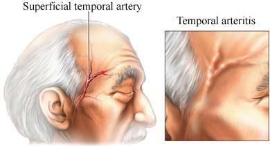 Illustration of superficial temporal artery and inflamed artery